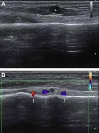 Periosteal Edema On Axial Stir Mri (Upper Row) And Coronal Stir... |  Download Scientific Diagram